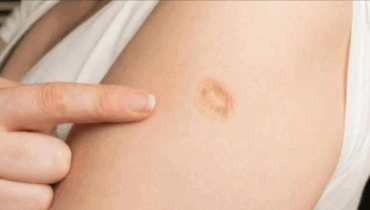 Why Do Millions of People Have a Small Scar on Their Left Arm? The Real Reason Revealed!