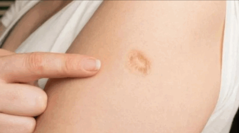 Why Do Millions of People Have a Small Scar on Their Left Arm? The Real Reason Revealed! arm scar meaning collective immunity disease eradication health history infectious diseases medical history medical triumph monkeypox public health science victory smallpox eradication smallpox scar smallpox vaccine vaccination history vaccine legacy