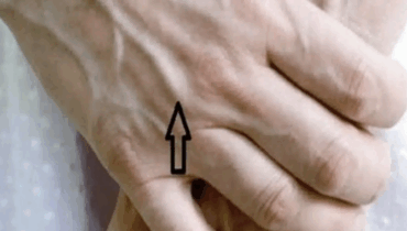 Visible Veins: What Do They Really Mean for Your Health?