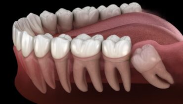 Your Dentist Isn’t Telling You This: The Vital Role of Wisdom Teeth