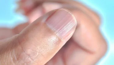 What Those Vertical Lines on Your Nails Really Mean – The Truth May Surprise You!