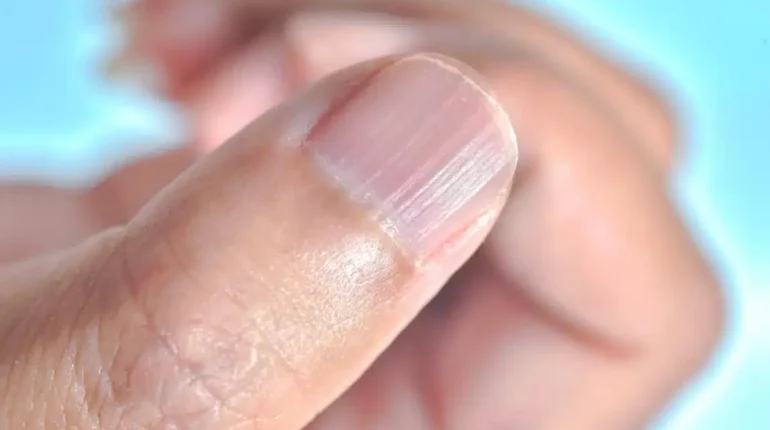 body digestive absorption fatigue symptoms health warning signs iron deficiency nail biting nail care nail health nutrition self-care stress effects thyroid function vertical nail ridges vitamin B12 