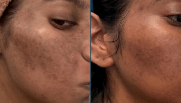 After 4 weeks with Medicube’s viral K-beauty routine, here’s what happened to my acne-prone skin…