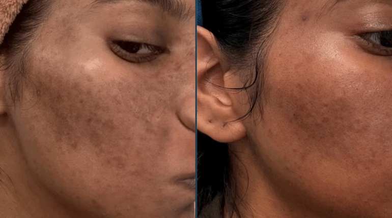 After 4 weeks with Medicube’s viral K-beauty routine, here’s what happened to my acne-prone skin… Acne-prone skin Beauty routine K-beauty Korean skincare Medicube PDRN Skincare