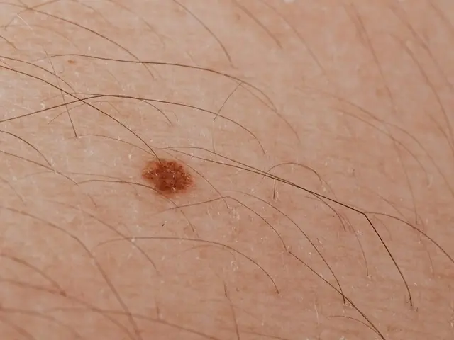 Unusual moles might be