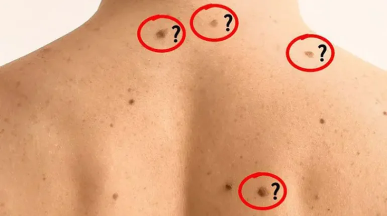 abnormal mole symptoms benign vs malignant moles cancerous moles melanoma signs mole treatment moles on skin skin cancer detection 