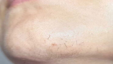 Chin Whiskers in Women: Causes, Health Effects & Best Solutions Revealed