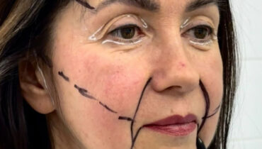Woman, 49, Stuns the Internet With Facelift — “She Looks 20 Years Younger!” Woman, 49, Stuns the Internet With Facelift — “She Looks 20 Years Younger!”