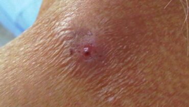 He Thought It Was Acne — It Was Something Much More Serious He Thought It Was Acne — It Was Something Much More Serious