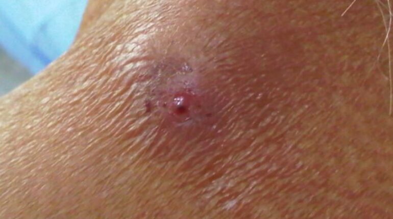 acne lookalikes dermatologist warning signs early skin cancer diagnosis fungal acne misdiagnosis persistent pimple won’t heal red bump on skin rosacea vs acne skin cancer vs acne suspicious skin lesions when acne isn’t acne 