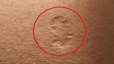 Smallpox vaccine scars: What they look like and why