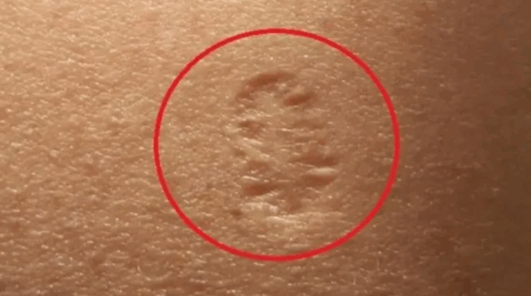 bifurcated needle smallpox history of smallpox vaccination smallpox eradication smallpox vaccine scar vaccine history 