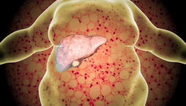 He never drank—but his liver failed. Doctors blame 4 everyday foods…