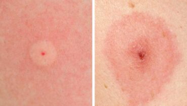 10 Common Bug Bites and How to Identify Them Fast 10 Common Bug Bites and How to Identify Them Fast