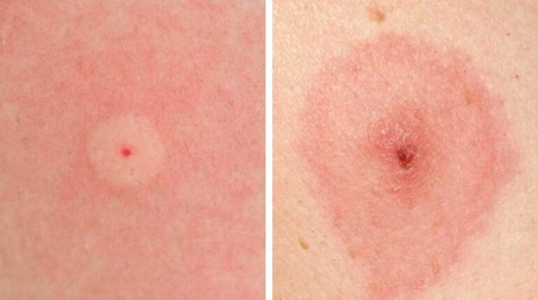 bee sting removal bug bite identification flea bite identification mosquito bite vs bedbug bite spider bite signs tick bite symptoms types of bug bites wasp sting treatment 