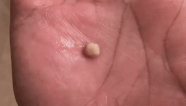 bad breath home remedies oral hygiene prevent tonsil stones throat health tonsil stone symptoms tonsil stone treatment tonsil stones tonsillectomy tonsilloliths 