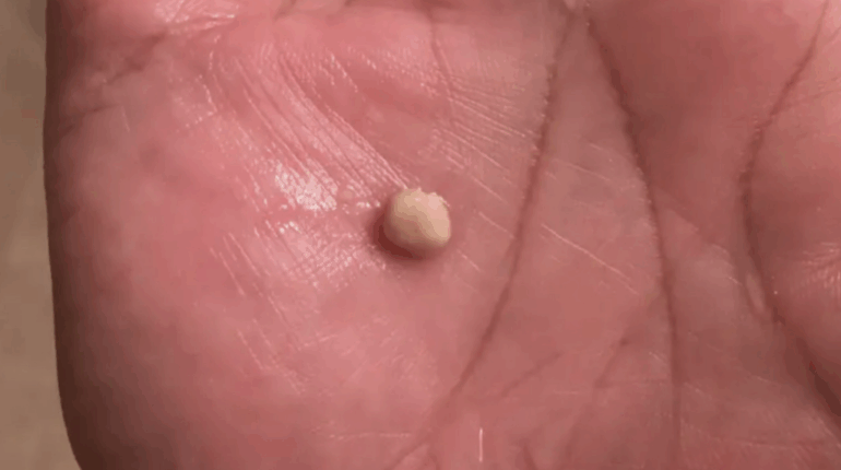 Surprising Signs of Tonsil Stones—And How to Get Rid of Them for Good bad breath home remedies oral hygiene prevent tonsil stones throat health tonsil stone symptoms tonsil stone treatment tonsil stones tonsillectomy tonsilloliths