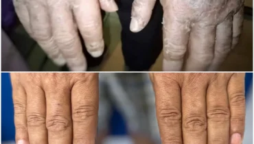 Mouth Cancer: Symptoms, Causes, Stages & Prevention Tips