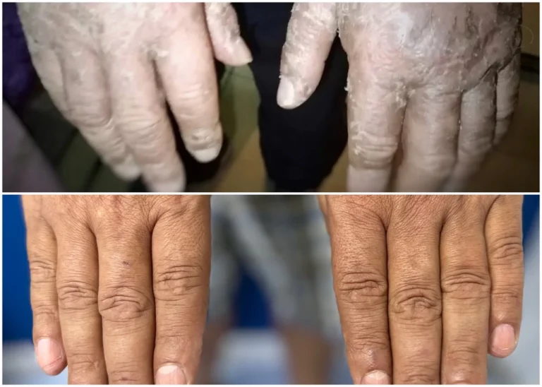 psoriasis-1-de-tamano-grande