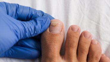 Lemon and Salt for Toenail Fungus – Natural DIY Remedy That Works