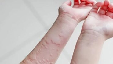 Amazing Causes Of Hives Revealed