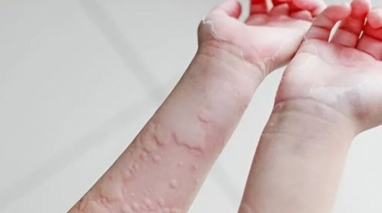 aquagenic urticaria chronic hives tips food sensitivities hives hidden allergens hives hives causes medication side effects hives pressure urticaria stress-induced hives sunlight urticaria surprising reasons for hives temperature urticaria urticaria triggers 