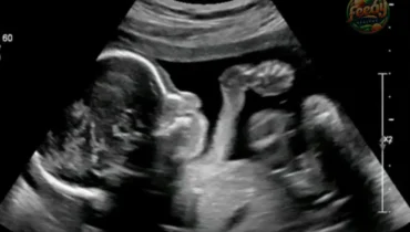 Off the Record: Groundbreaking Study Links Gut Health to Autism Risk — Starting in the Womb Off the Record: Groundbreaking Study Links Gut Health to Autism Risk — Starting in the Womb