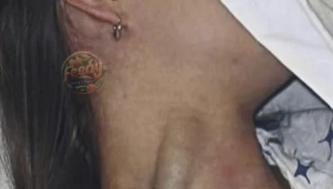 Massive Jugular Distension: A Warning Sign You Shouldn’t Ignore