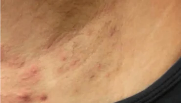 Hidradenitis Suppurativa Affects 1% Globally, New Study Finds Hidradenitis Suppurativa Affects 1% Globally, New Study Finds