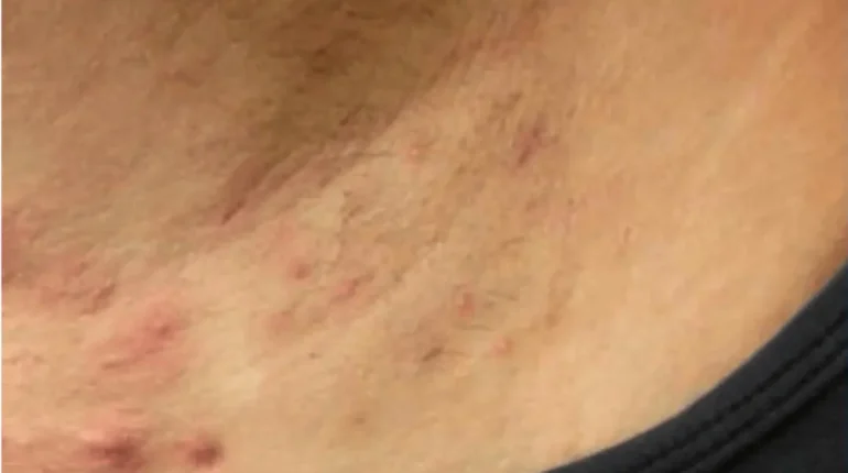 hidradenitis diagnosis hidradenitis suppurativa HS global study HS meta-analysis HS prevalence HS women risk 