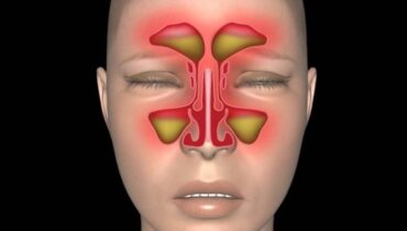 Natural Sinus Infection Remedies: Effective Relief Without Antibiotics
