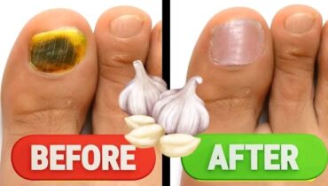Garlic Remedies That Wipe Out Fungal Infections Fast… Garlic Remedies That Wipe Out Fungal Infections Fast…