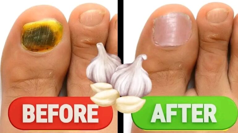antifungal properties of garlic garlic antifungal remedy garlic athlete’s foot treatment garlic for nail fungus garlic home remedies natural scalp fungus cure 