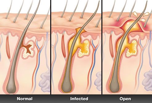HS Impact on Patients