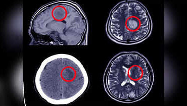 12 signs that may signal a brain aneurysm — Don’t ignore them