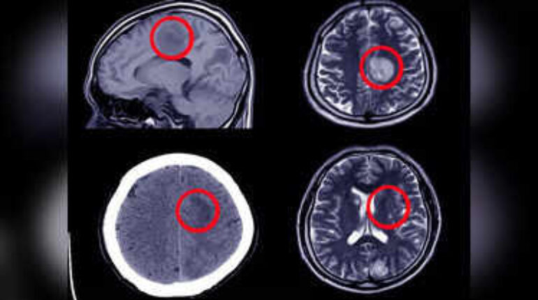 aneurysm headache sign aneurysm urgent care aneurysm warning signs brain aneurysm detection brain aneurysm prevention tips brain aneurysm risk brain aneurysm symptoms early signs brain aneurysm neurological emergency symptoms worst headache of my life 