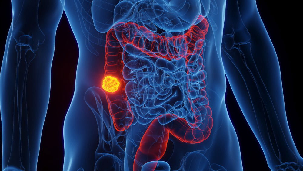 How to Support Colon