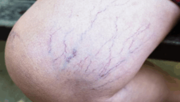 Purple Veins on Legs: Hidden Dangers, Symptoms & Effective Remedies