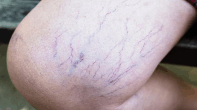 cardiovascular veins causes of purple veins compression stockings diabetes veins leg circulation tips leg vein remedies leg vein symptoms purple veins on legs varicose prevention venous insufficiency 