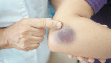 Waking up with bruises on your legs, a dangerous sign that you should not ignore