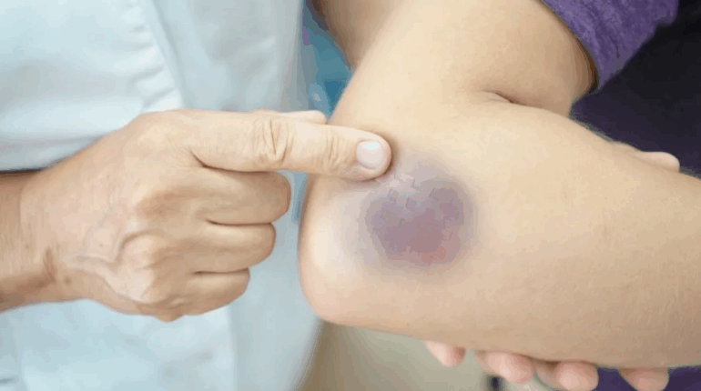 aging bruises blood disorder bruises bruise treatment cold compress for bruises diabetes bruising hormonal imbalance bruises morning bruises on legs purpura causes unexplained bruises vitamin deficiency bruises 