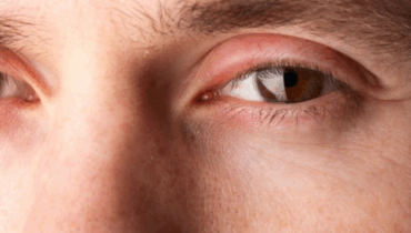 Puffy eyes when waking up: 6 causes and remedies