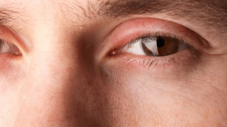 allergy eye swelling cold compress for eyes diet and eye puffiness eye puffiness causes kidney function puffiness lack of sleep eye bags morning eye swelling remedies potato slices for puffy eyes puffy eyes in the morning swollen eyelids 