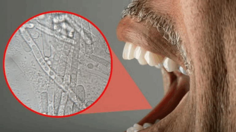 bactéries buccales crise cardiaque hygiène bucco-dentaire inflammation artérielle maladie coronarienne plaques artérielles prévention santé santé cardiovasculaire streptocoques viridans Tampere University 