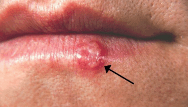 If you see this appearing on your lips, it is a sign of ca… If you see this appearing on your lips, it is a sign of ca…