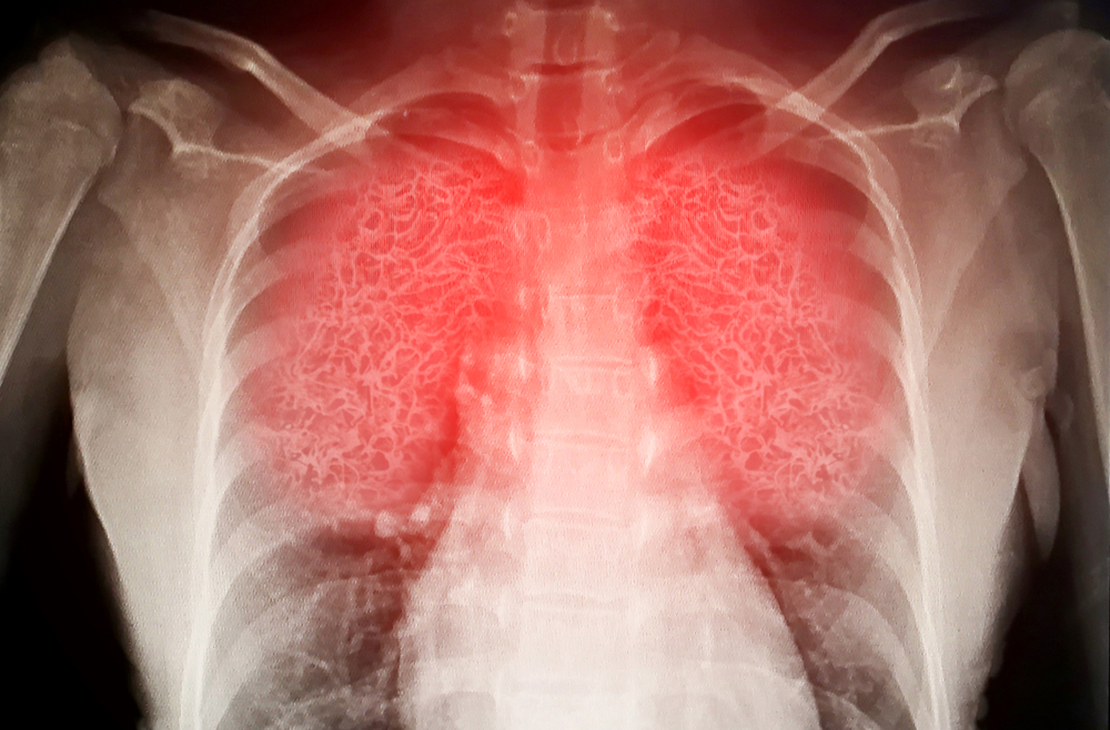 Pneumonia herbal relief