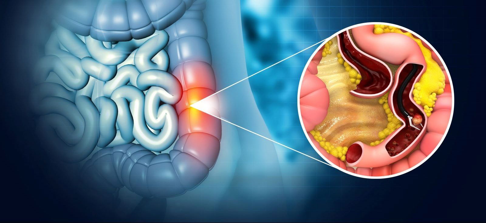 How to Support Colon