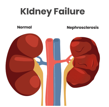 Woman lost both kidneys