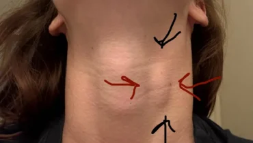 What Do Neck Lumps Really Mean?