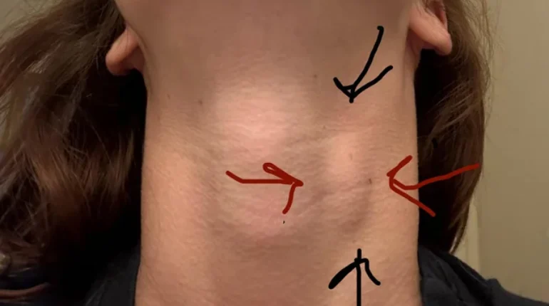 benign neck lump causes of neck lumps cyst in neck hard lump in neck lipoma neck lump under jaw lymphadenopathy neck cyst treatment neck lump cancer neck lump diagnosis neck lump symptoms neck lumps neck swelling neck tumor painless neck lump salivary gland swelling swollen lymph nodes thyroid cancer lump thyroid lump when to see doctor for neck lump 